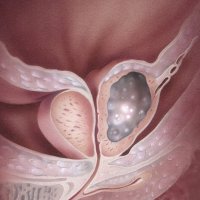 Hlavní obrázek - Fúzní biopsie prostaty značně zefektivní diagnostiku karcinomu
