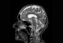 Hlavní obrázek - Bickerstaff brainstem encephalitis and Guillain-Barré syndrome overlap