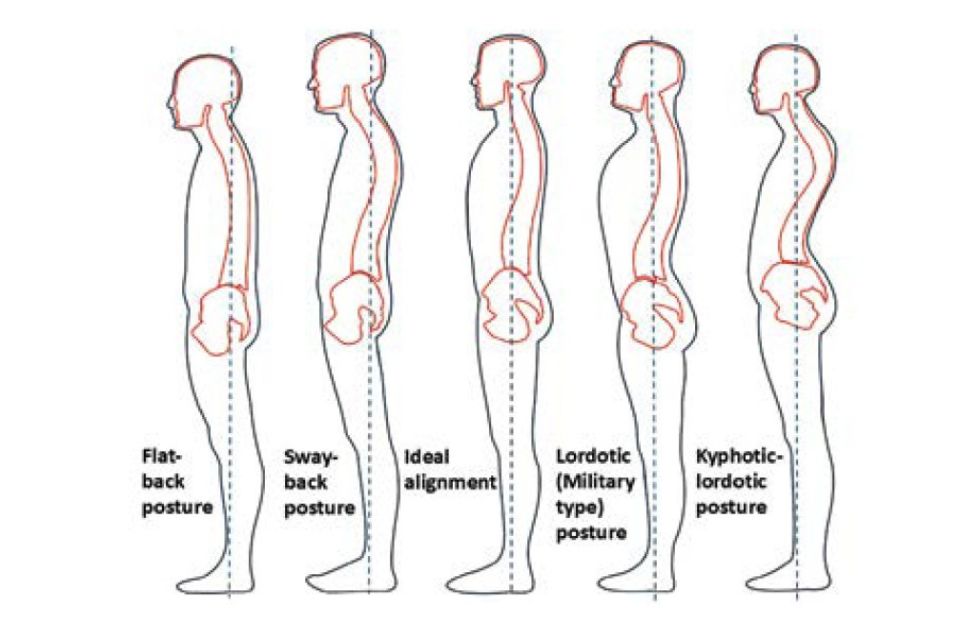 Hlavní obrázek - Hodnocení orientace pánve, typu zakřivení páteře a držení těla v sagitální rovině
